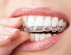 Dentist in Plano Texas Invisalign