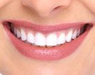 Teeth Whitening in Plano