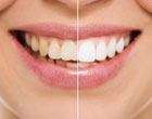 Dentist in Plano Texas Veneers